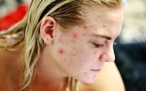 Acne Vulgaris: Uzroci, Simptomi i Savremene Metode Lečenja