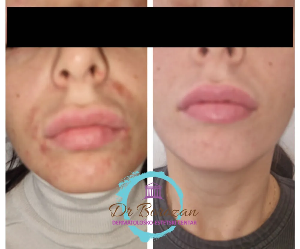 Klinička slika perioralnog dermatitisa