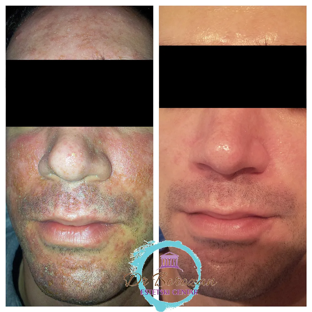 Seboroični dermatitis dijagnostika i klinička slika