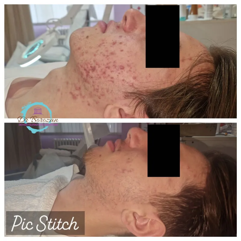 Acne Vulgaris kod pacijenta