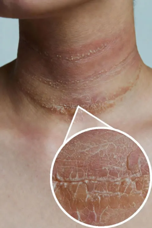 NEURODERMATITIS (Lichen Simplex Chronicus): Uzroci i Lečenje