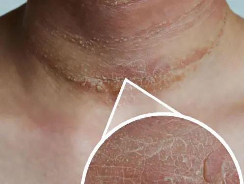 NEURODERMATITIS (Lichen Simplex Chronicus): Uzroci i Lečenje