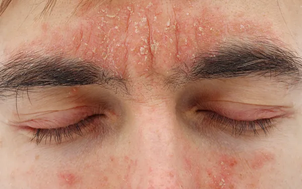 Seboroični dermatitis: Uzroci, Simptomi i Metode Lečenja